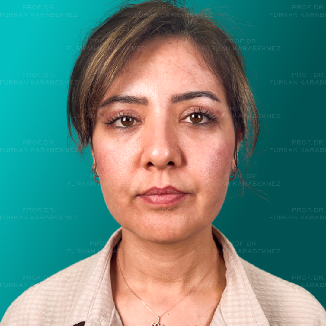 Göz Kapağı Estetiği Ankara