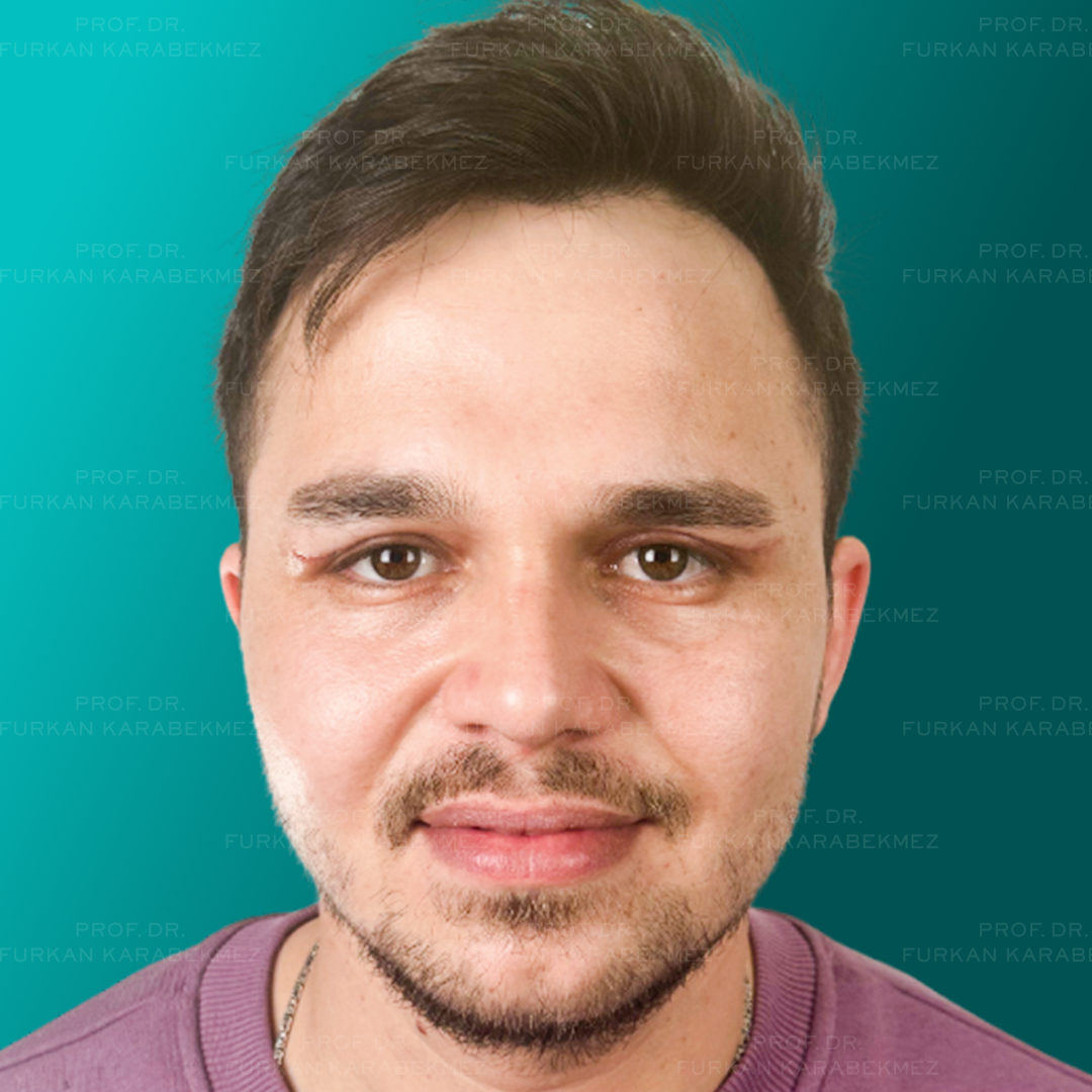 Göz Kapağı Estetiği Ankara