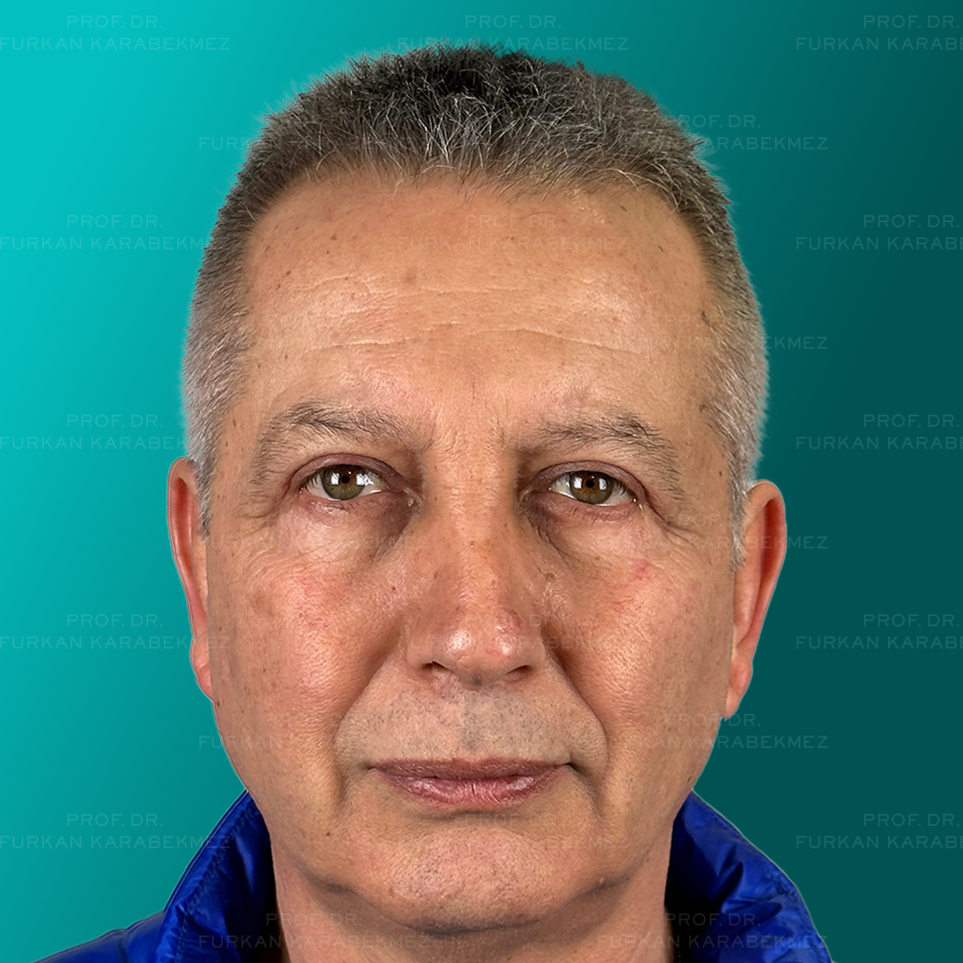 Göz Kapağı Estetiği Ankara