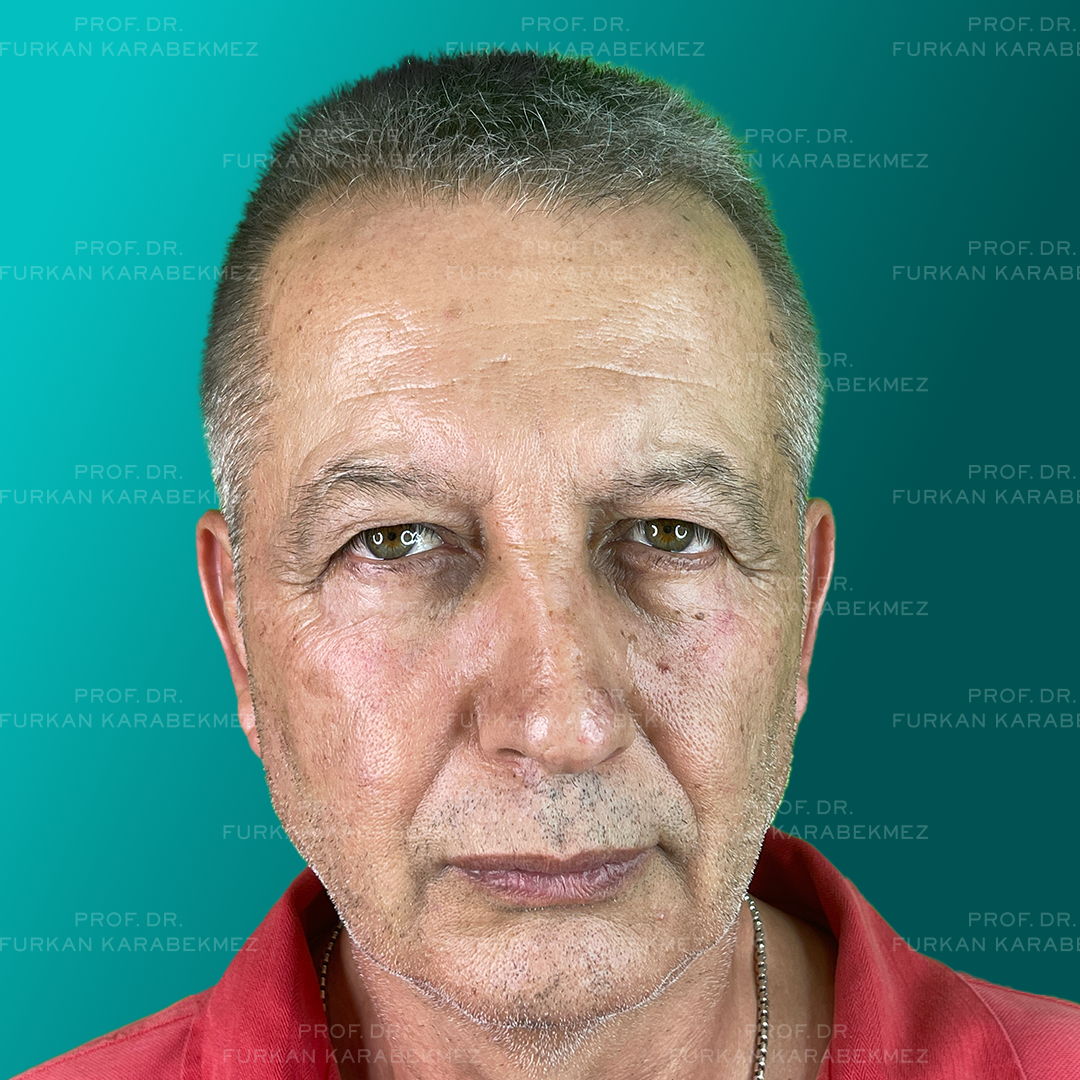 Göz Kapağı Estetiği Ankara